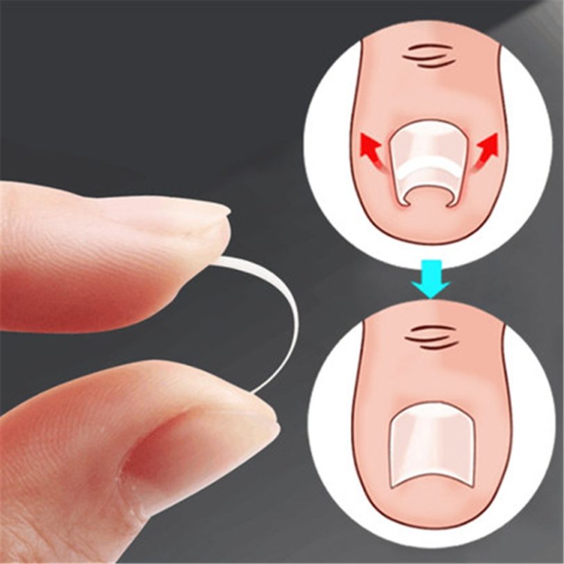 10pcs Ingrown Toenail Correction Tool Ingrown Toe Nail Treatment Elastic Patch Sticker Straightening Clip Brace Pedicure Tool - Image 5